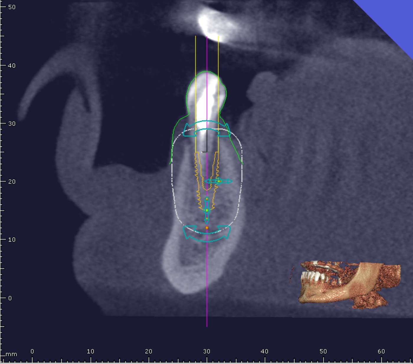 Corte tomográfico mostrando o implante e a margem de segurança ao canal mandibular