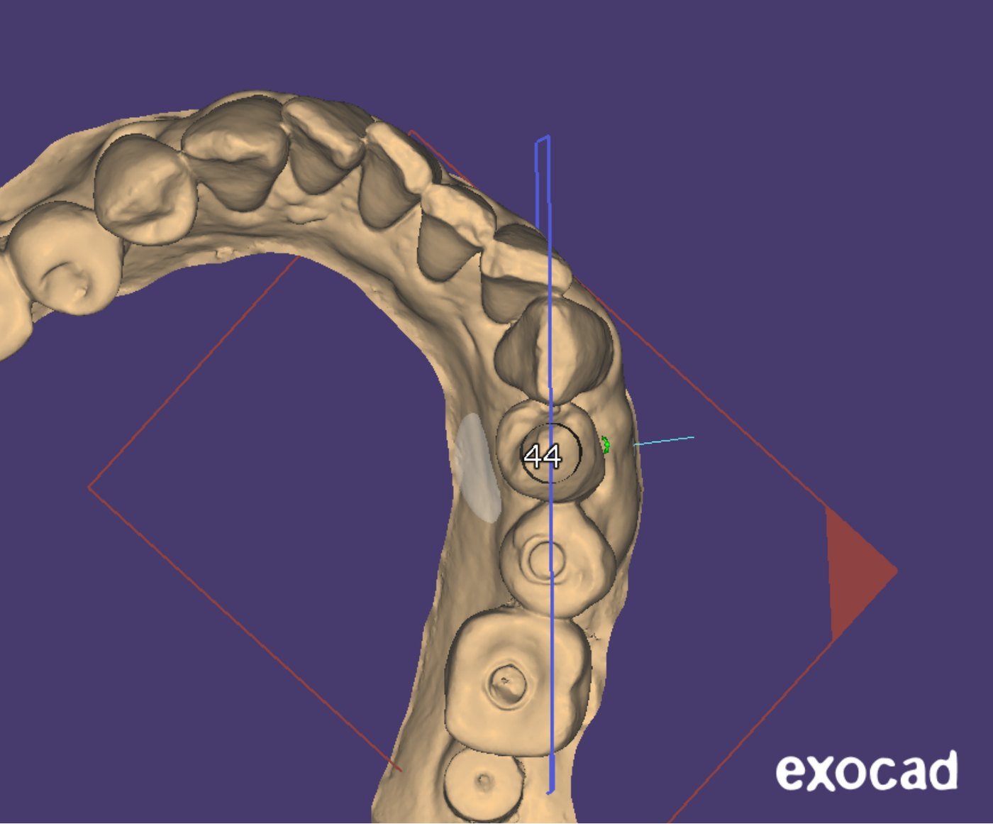 Arcada 3D escaneada com a posição do dente 44 marcada no planejamento digital