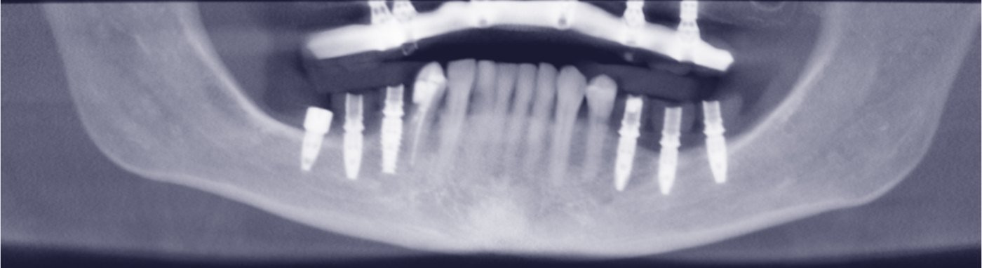 Radiografia panorâmica reconstruída a partir da tomografia do paciente
