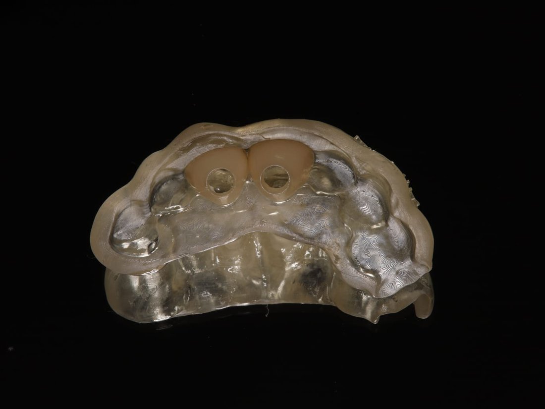 Guia cirúrgico apoiado sobre o modelo com os dentes